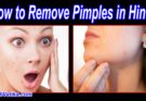 How to Remove Pimples in Hindi